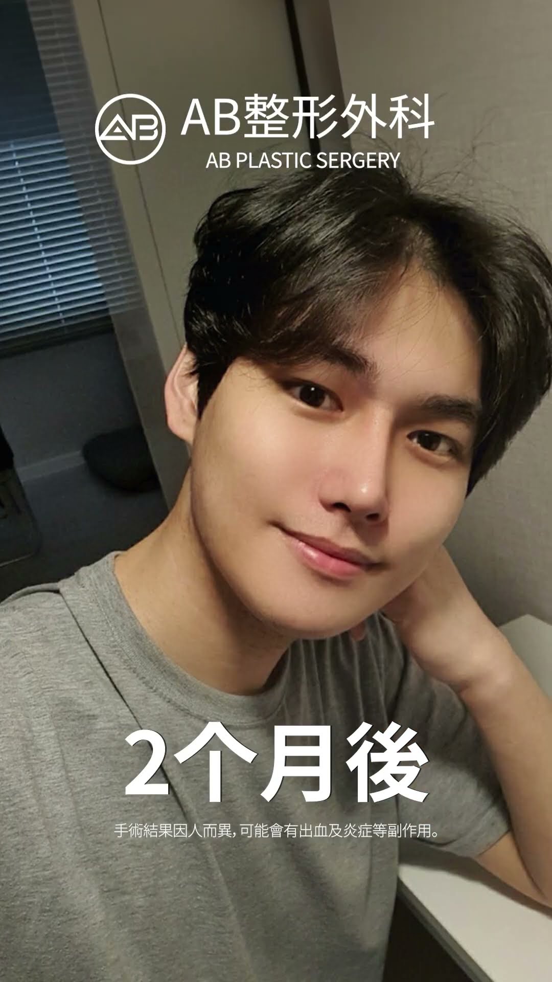 终极蜕变：下颌、鼻子和眼睛手术前后对比 #抖音 #为你推荐