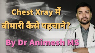 Chest X-ray of Lung disease explained in hindi by Dr.Animesh MS #dranimesh #surgeryonline #pneumonia screenshot 4