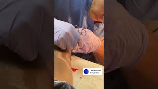 Achilles Rupture stitches removal #subscribe #shorts #surgery