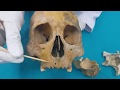 Anatomi Kemikler Ossa Cranii-Viscerocranium Kemikleri-Os Maxilla Anatomisi