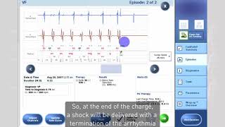 oversensing 3