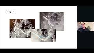 Dr. Karl Van Osten OTA 2024 Virtual Webinar: CurvaFix in High Energy Acetabulum Fractures