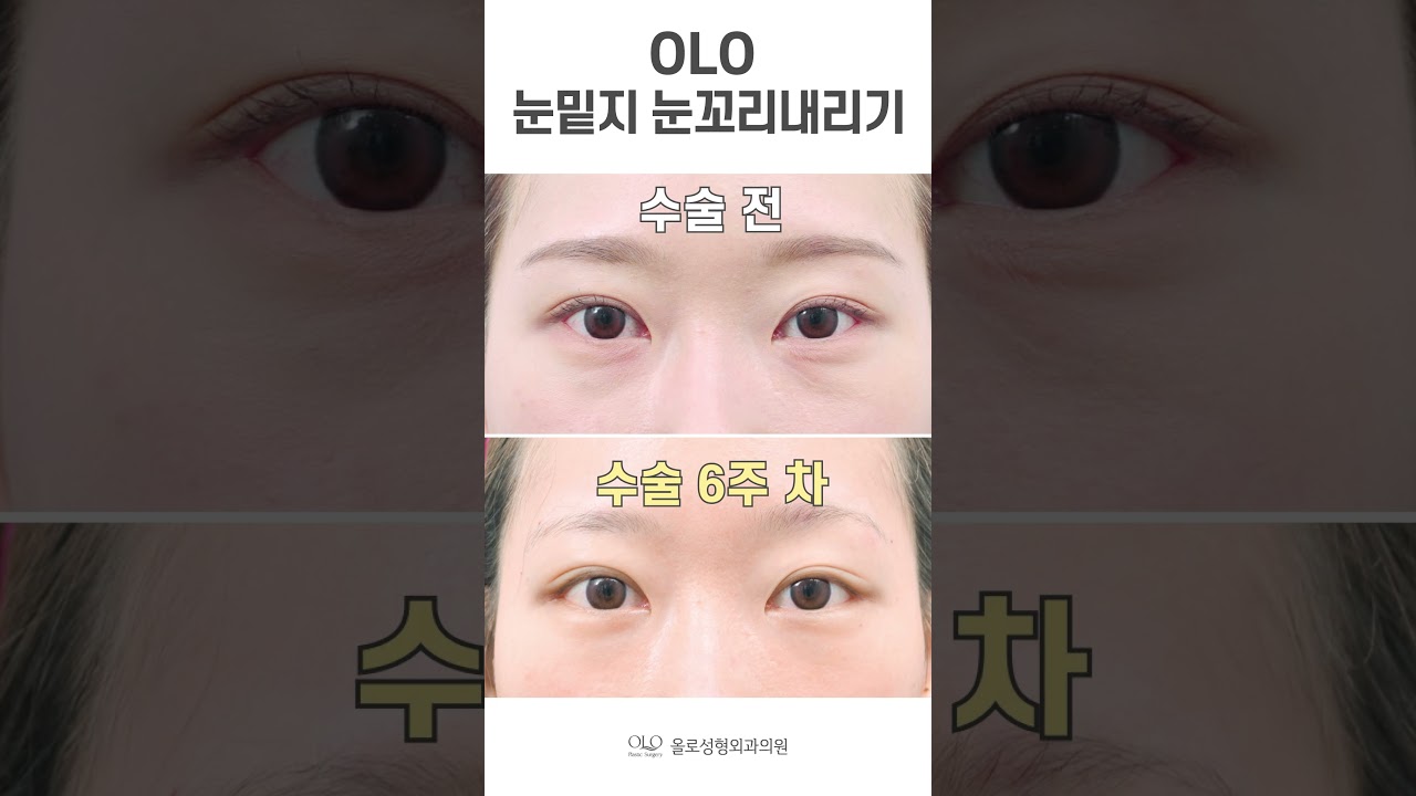 [Олло гоо сайхны мэс заслын эмнэлэг] #Гөлөгний нүдний хэлбэр хэцүү биш ээ~ #Нүдний доорх хар хүрээ #Нүдний доорх өөхний байршлыг өөрчлөх шийдэл~ #шорт