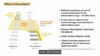 Part 3: Monovision and Blended Vision: Advance Laser Treatments for Presbyopia