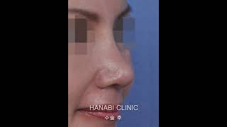 [하나비] 코끝 처짐 교정 코재수술 [전후사례] #코끝처짐 #코재수술