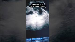 trending pregnancy youtubeshorts NT scan