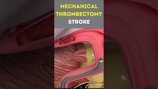 This Procedure Saves Thousands Of Stroke Patients #medical #doctor