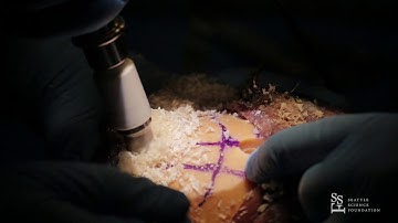 Slow Motion Craniotomy