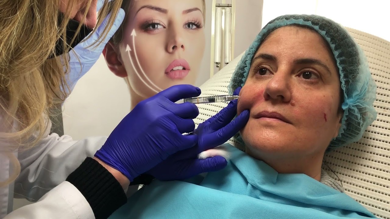 FILLER: rivolumetrie del volto