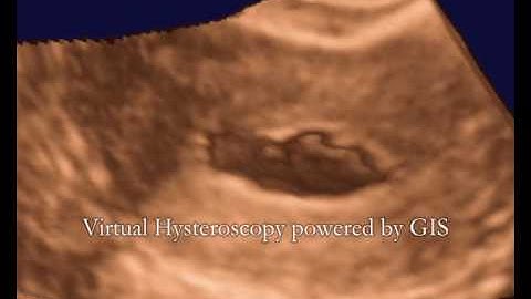 GIS-Kit shows better results of a uterine ultrasound