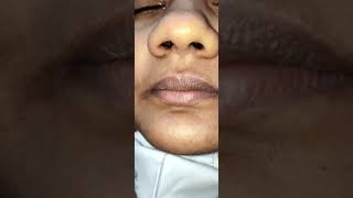 Nose Examination  External and Anterior Rhinoscopy       Dr Mohan Bansal