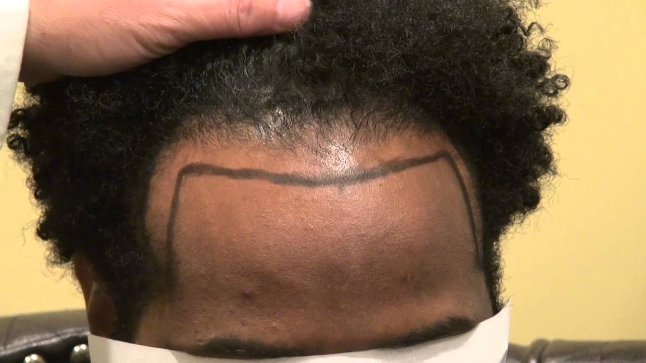 African American Bald Hair Loss Treatment Solution Restoration Dr within African American Hair Growth Products For Men