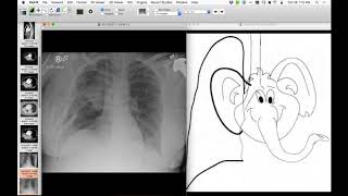 STR Cardiothoracic Case Webinar 10/26/2017