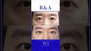 WILL BE 남자눈성형 B&amp;A👀  #윌비성형외과 #김준영원장 #willbe #신사역성형외과 #강남눈성형 #남자눈매교정 #눈성형잘하는곳 #눈성형전후 #눈성형후기 #눈수술