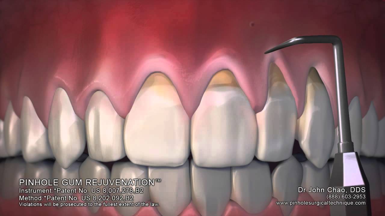 Dallas-Fort Worth Dentist: Chao Pinhole Gum Rejuvenation