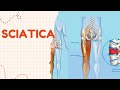 Sciatica Pain? Causes, Symptoms & diagnosis and treatment|#BackPainRelief #SciaticNerve#LegPain