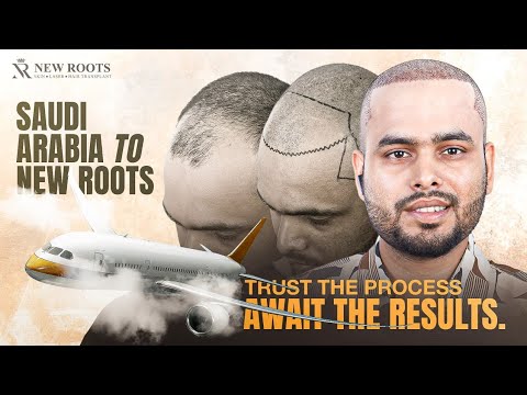 Saudi Arabia → Bangladesh… The Hair Journey Begins! 😃 | Hair Transplant in Bangladesh | New Roots