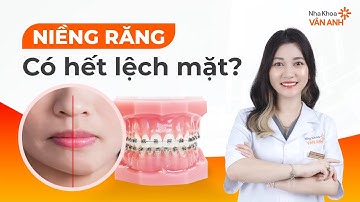 Niềng răng có hết lệch mặt không? 5 yếu tố quan trọng