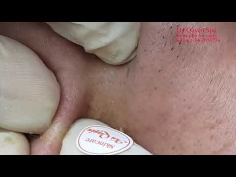 Acne treatment in Ha Quyen Spa on //  - Điều trị mụn tại Hà Quyên Spa