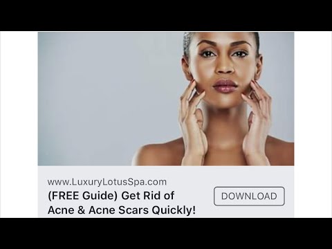  tips for acne prone skin - The acne free skin care series starts tomorrow | Luxury Lotus Spa