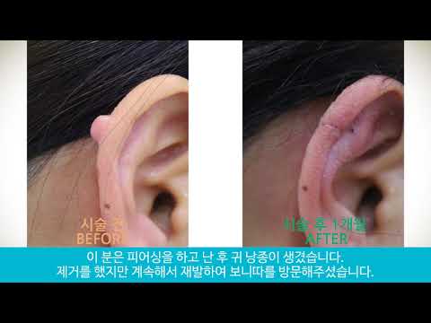 귀낭종 제거 (  Remove ear cysts )