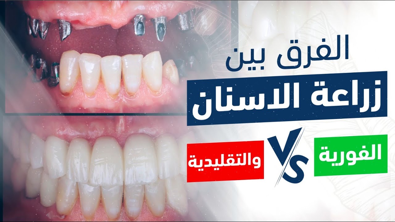 الفرق بين زراعة الاسنان الفورية و التقليدية | مخاطر زراعة الاسنان الفورية - العيوب والممنوعات