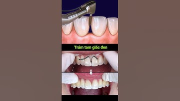 Trám tam giác đen, lấy lại thẩm mỹ cho hàm răng #nhakhoa #tramrang #filling #dentist #dental