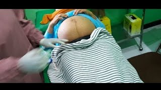 Hamil 39 minggu riwayat sc