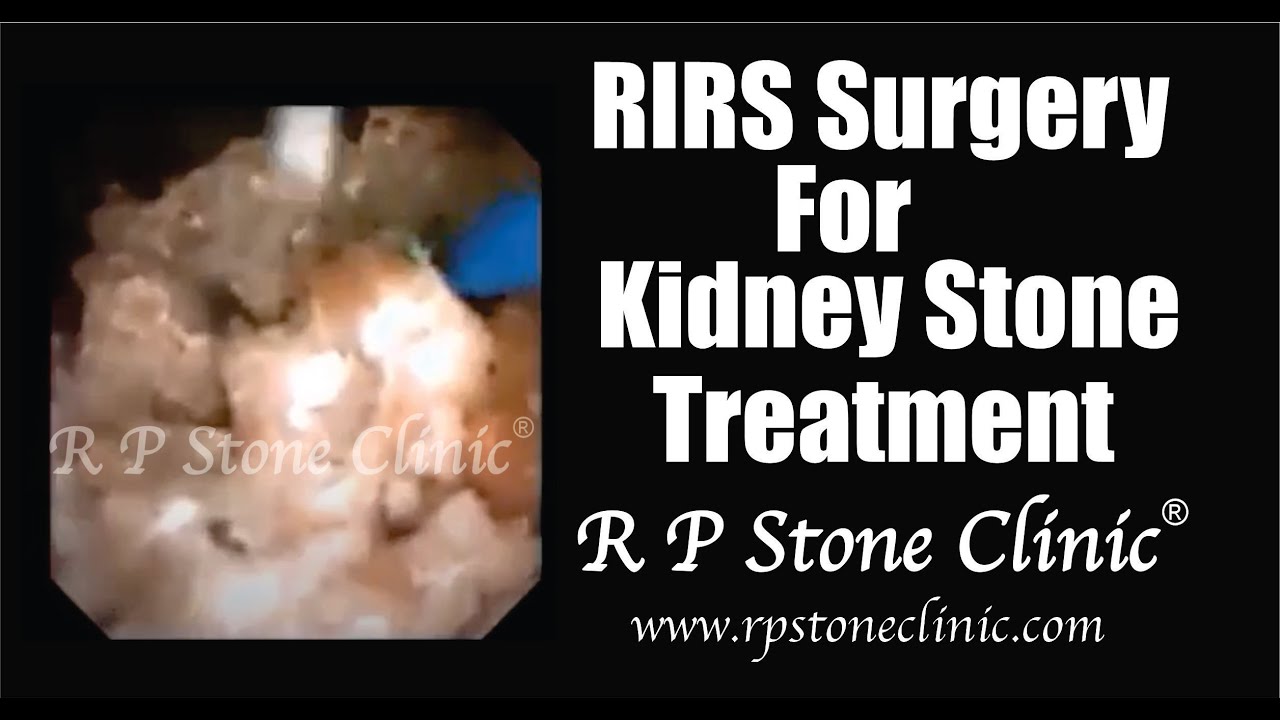 Kidney Stone Treatment by RIRS Surgery in a Horseshoe Kidney YouTube