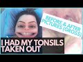Adult Tonsillectomy | My Experience &amp; Advice (PICTURES)