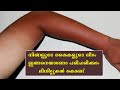 നിങ്ങളുടെ കൈകള്‍ ഇങ്ങനെയാണോ വിഷമിക്കേണ്ട വെളുപ്പിക്കാം   /Instant sun tan removal