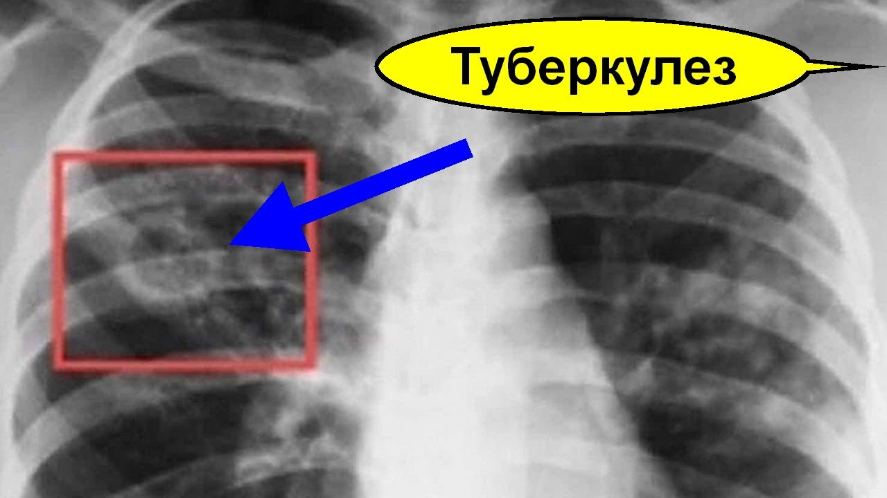 Способы ликвидации туберкулеза. Аортосклероз легких что это такое и как лечить. Пробитое легкое как лечат. Ликвидация туберкулеза