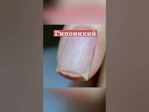 ГИПОНИХИЙ, ЧТО ЭТО И КАК ИЗБАВИТЬСЯ??? Наросла кожа под ногтем, как ...