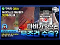【허리】 디스크마비 자가진단으로 마비가 관찰된 경우.. 허리수술 무조건 해야 하나요?  [수술이 필요한 마비종류 필수체크✔️] ㅣ닥발TV