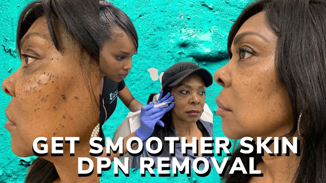 dpn-removal-for-smoother-skin-youtube