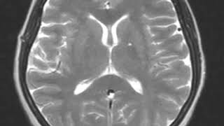 Sinus thrombosis, pseudotumor cerebri, and seizure disorder