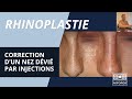 Correction dun nez dvi par rhinoplastie mdicale injections  dr niforos lyon