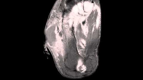 Synovial Sarcoma, Foot