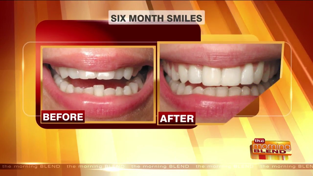 The Different Advancements in Modern Orthodontics YouTube