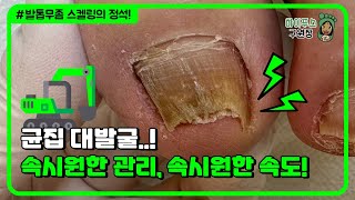 ...누르는 것들 시원하게 발굴하고 깔-끔하게 무좀 스켈링! / Ingrown toenail / toenail fungus