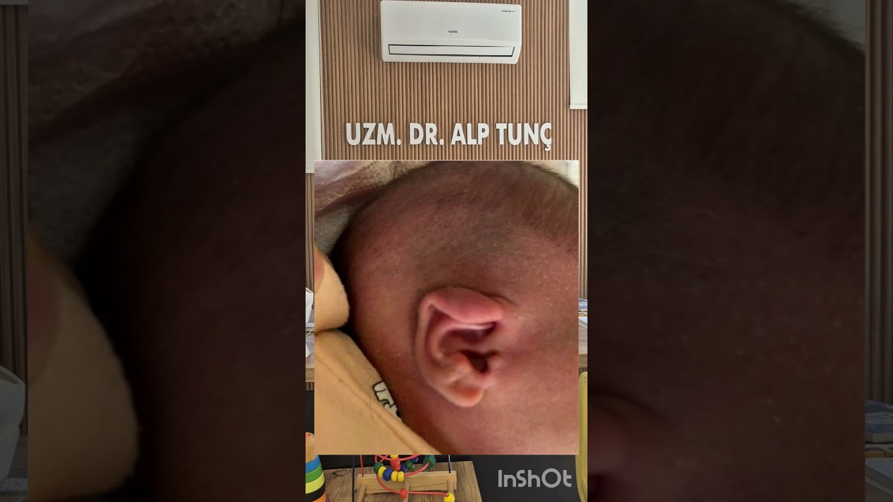 Bebeklerde kulak şekil bozuklukları, lidding deformitesi ( bebeklerde kulak katlanması)