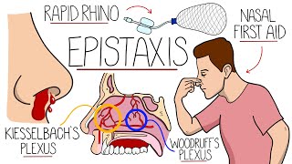 Understanding Epistaxis (Nosebleeds Explained)