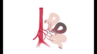 Recognizing acute mesenteric ischemia