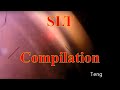 Selective laser trabeculoplasty slt compilation chris teng md