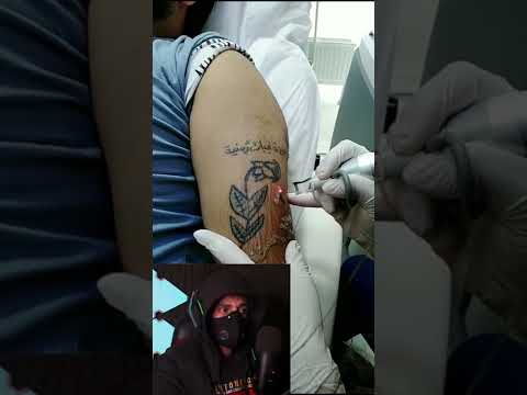 شعور اللي يزيل الوشم بالليزر