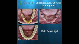 Full Arch Su 8 Impianti Arcata Inferiore