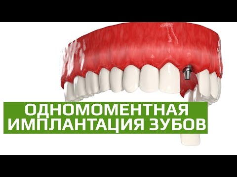 Двухэтапная  имплантация. Одномоментная имплантация с подсадкой костной ткани