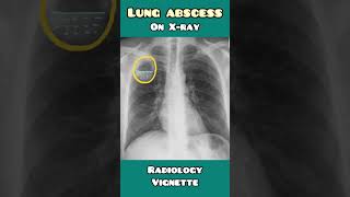 Lung Abscess on Chest X-ray easy explanation for USMLE, NEET PG, NCLEX, INICET