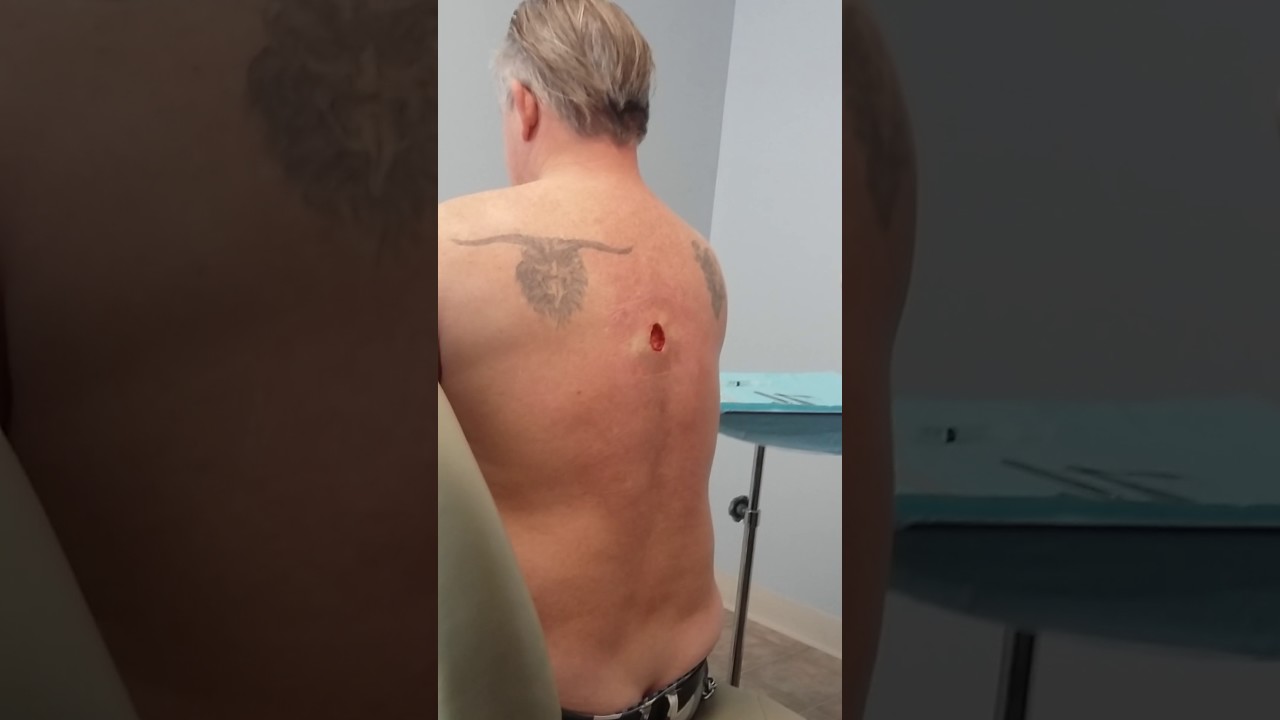 MOHS Micrographic Surgery. YouTube