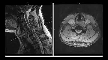 Unilateral Facet Dislocation; Literature Review